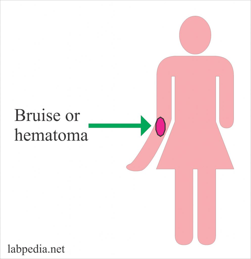 Blood Sample: – Part 1 – Complications during blood collection