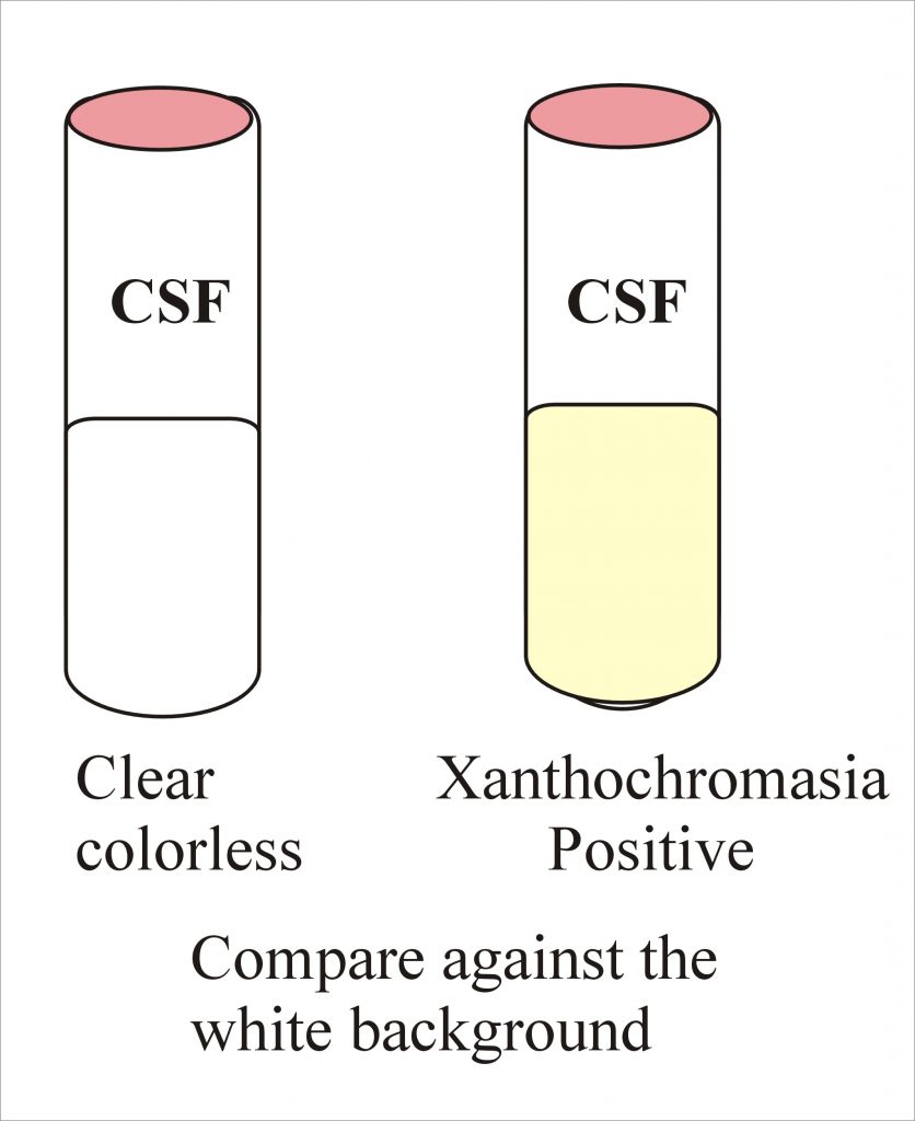 CSF xanthochrmia comparison CSF xanthochrmia comparison