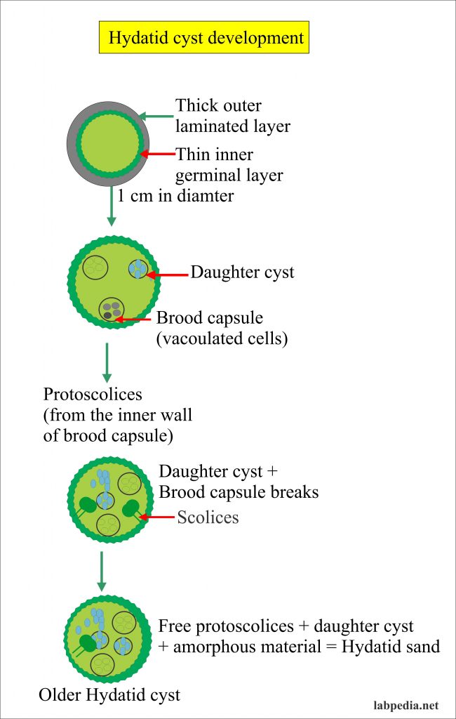 Echinococcus Granulosus, Hydatid Disease, Hydatid Cyst Echinococcus Granulosus, Hydatid Disease, Hydatid Cyst