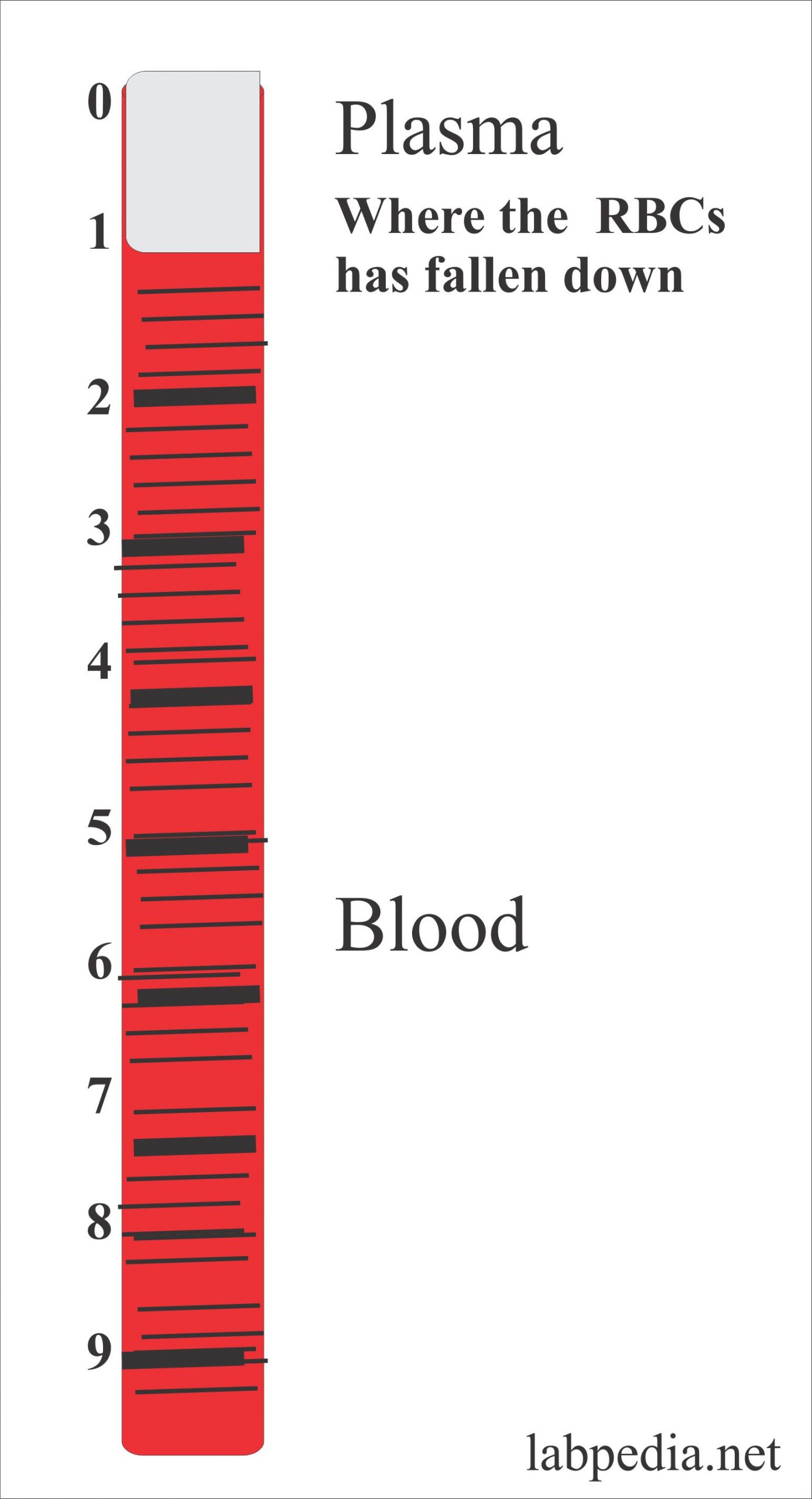 Erythrocyte Sedimentation Rate:- Part 2 – ESR Solution and Procedure