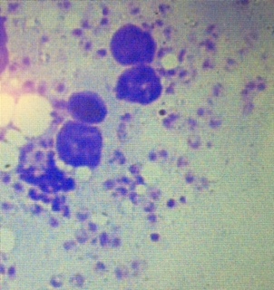LT bodies in the histiocyte