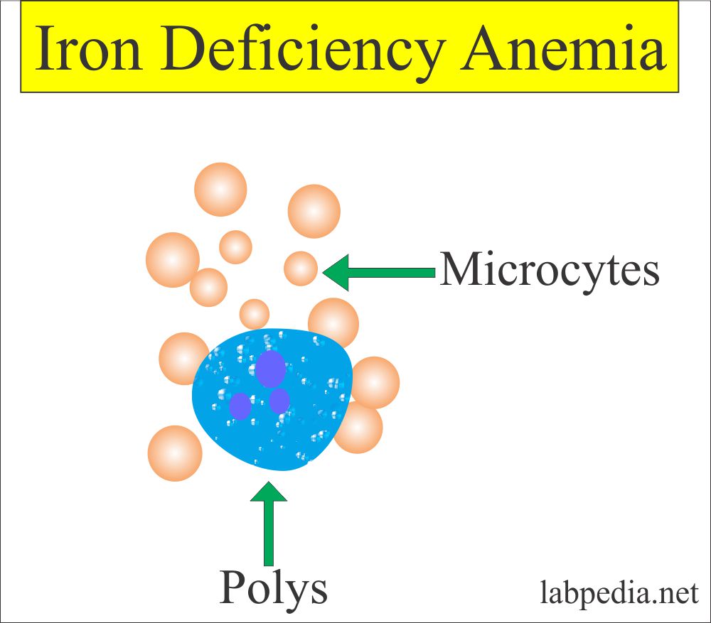 Iron deficiency anemia blood picture