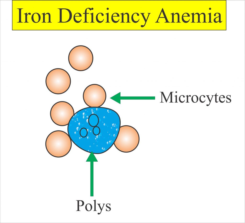 Mean Corpuscular Volume (MCV), Mean Cell Volume