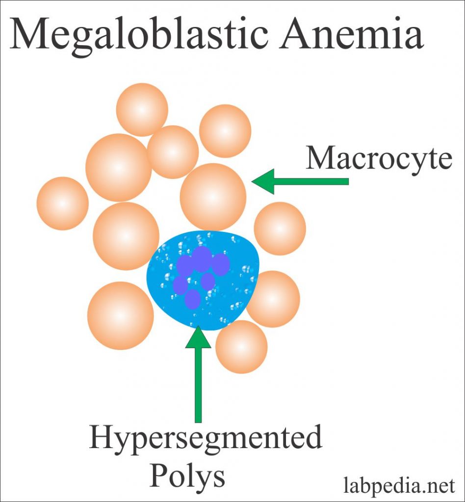 Megaloblastic anemia blood picture