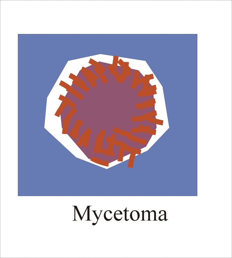 Typical Mycetoma
