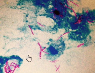 Acid-Fast Bacilli Culture: AFB Stain for Mycobacteria 