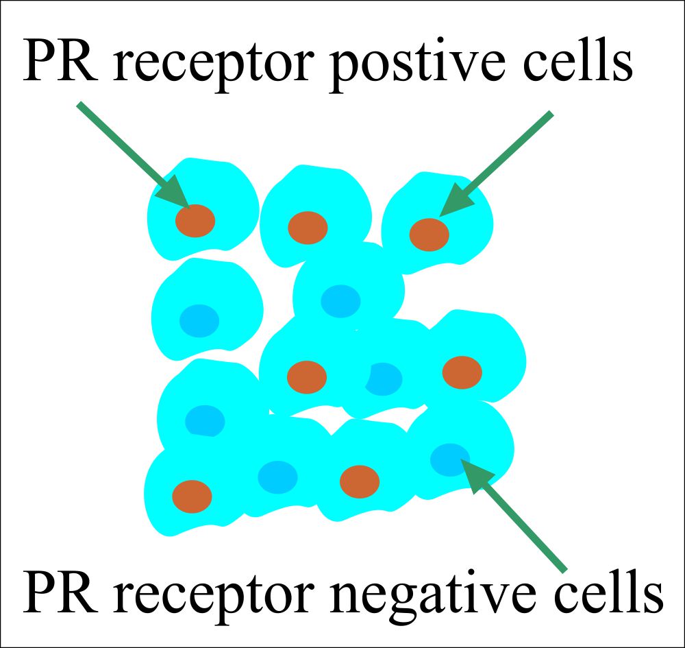 PR / ER-positive and Negative Cells