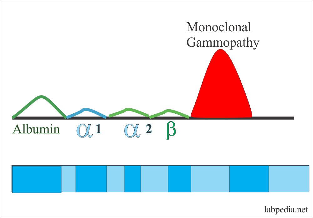 Electrophoresis Monoclonal Gammopathy