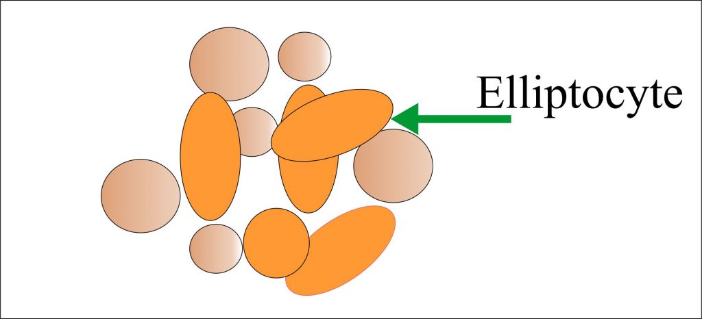 Elliptocytes Elliptocytes