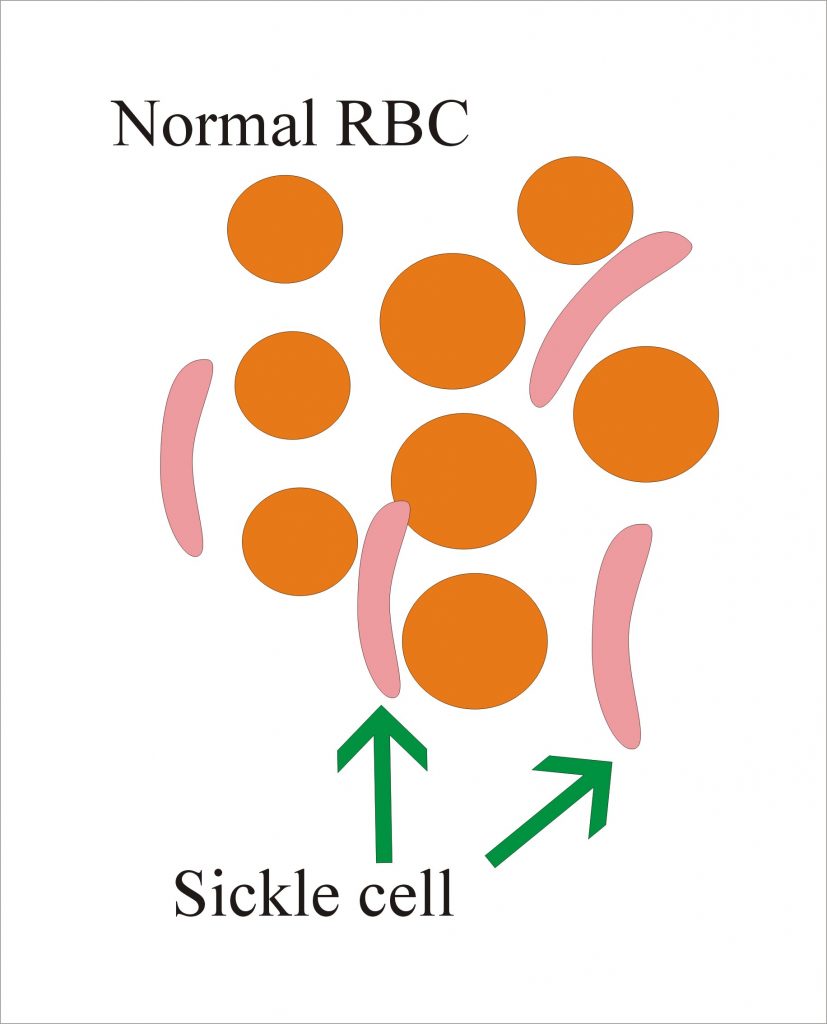 Sickle cell shape