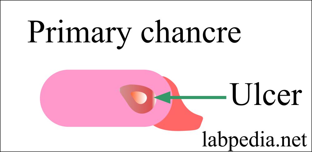 Primary Chancre on Penis