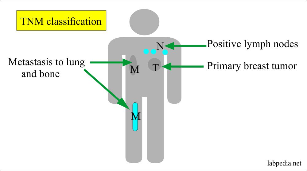 TNM staging and Lymph nodes status