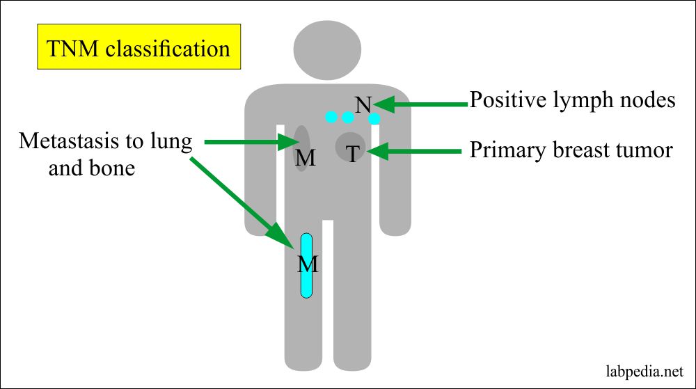 Tumor Marker – Part 1 – Definition of Tumor Markers, Staging and Grading
