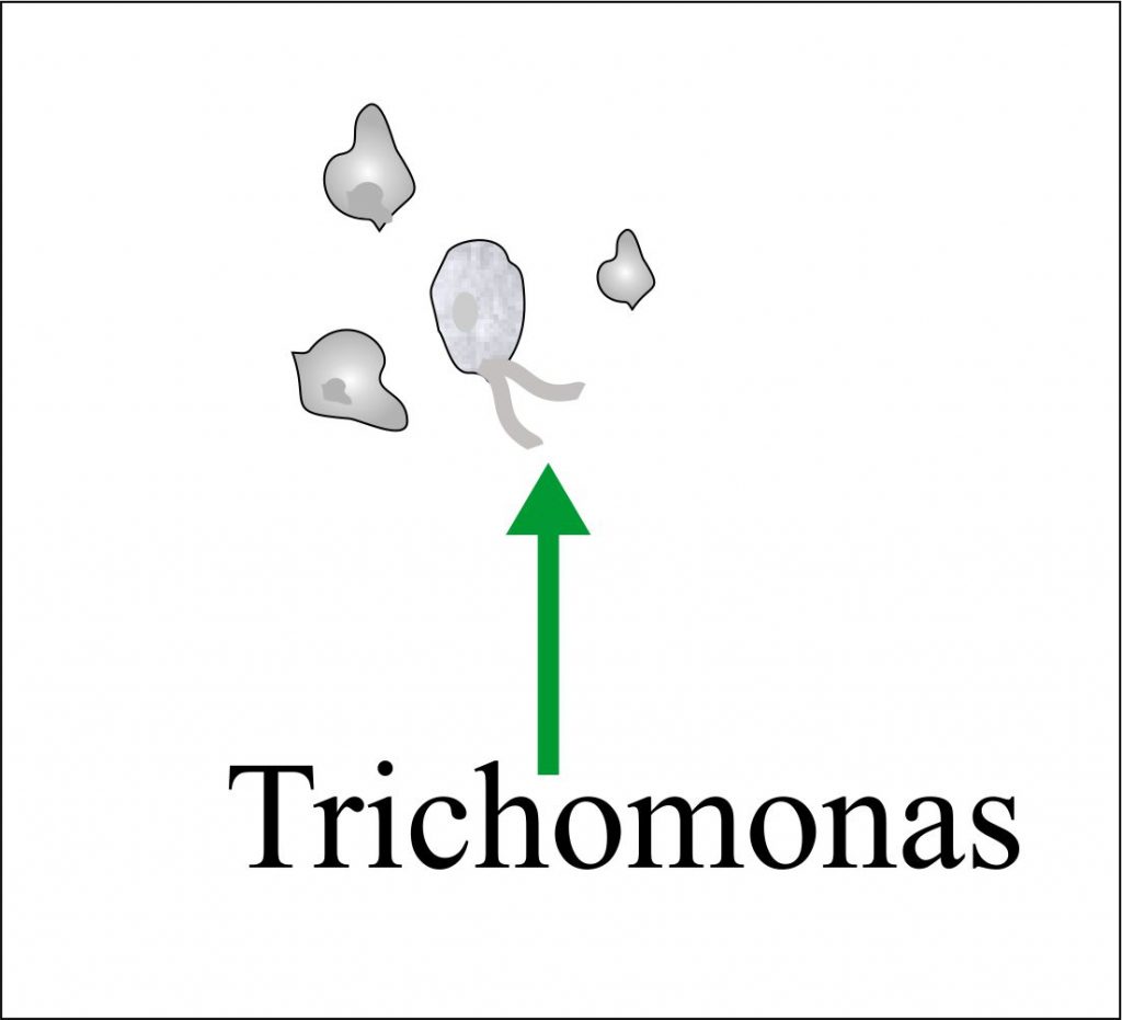 Urine Trichomonas Urine Trichomonas