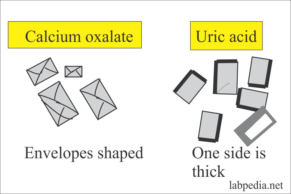 Urine Analysis part 8 Urine Crystals (Crystalluria)