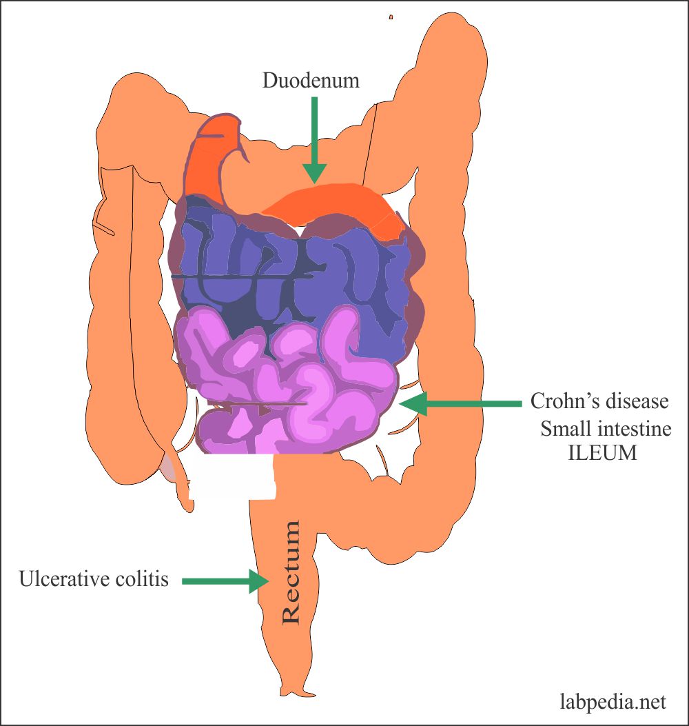 ulcerative colitis and crohn's disease
