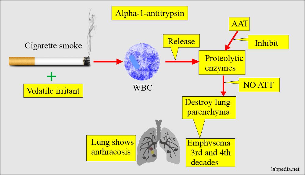AAT deficiency and smoking cigarette cause emphysema