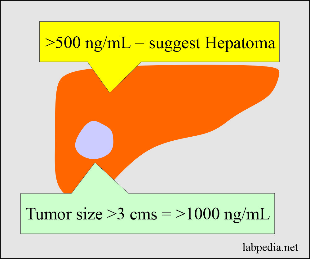 AFP in Liver cell carcinoma (Hepatoma)
