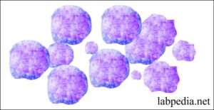 Acute Leukemias and their Diagnosis, Acute Myelocytic and ...