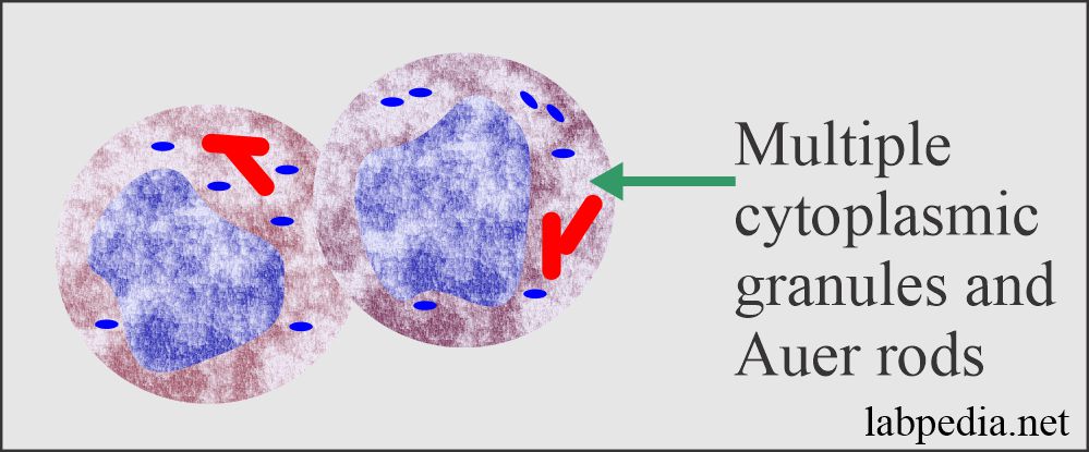 Acute Leukemias and their Diagnosis, Acute Myelocytic and Acute Lymphocytic Leukemia