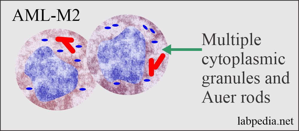 Acute myeloid leukemia (AML= M2)