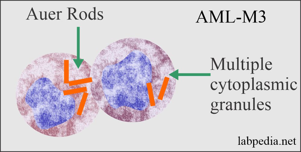 Acute myeloid leukemia (AML= M3)