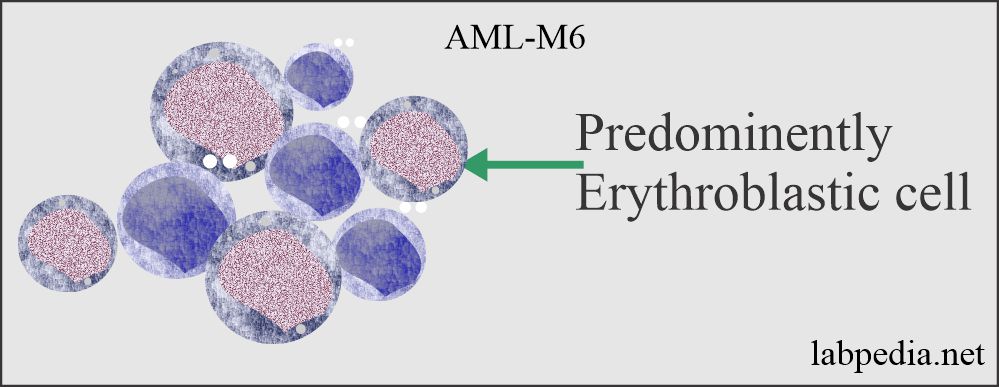 Acute myeloid leukemia (AML= M6)