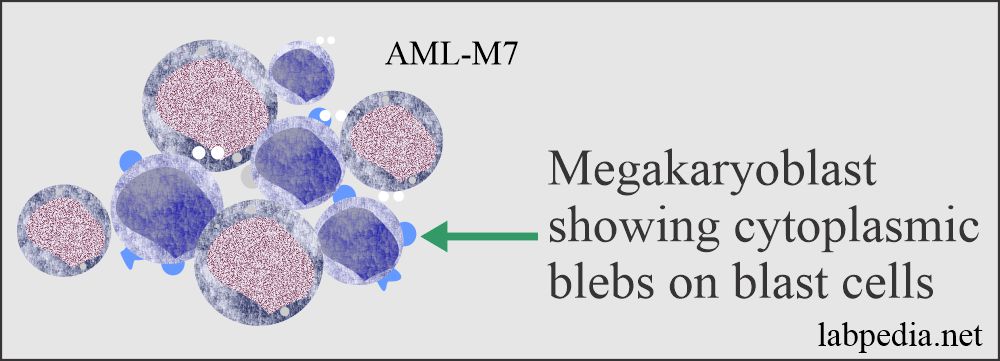 Acute myeloid leukemia (AML= M7)