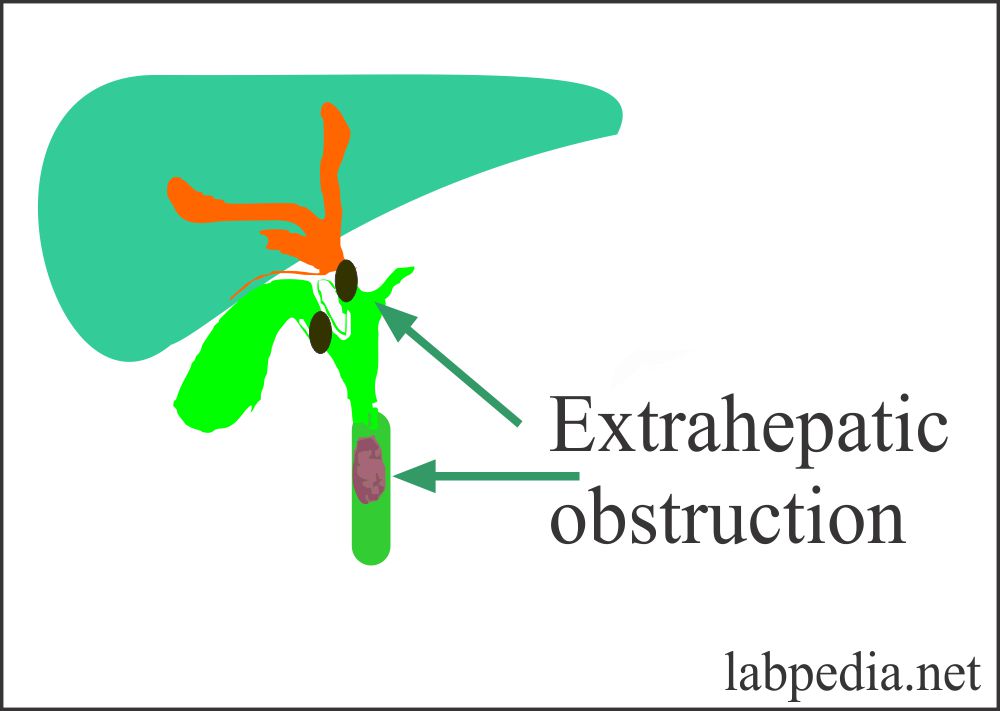 Alkaline phosphatase extrahepatic obstruction