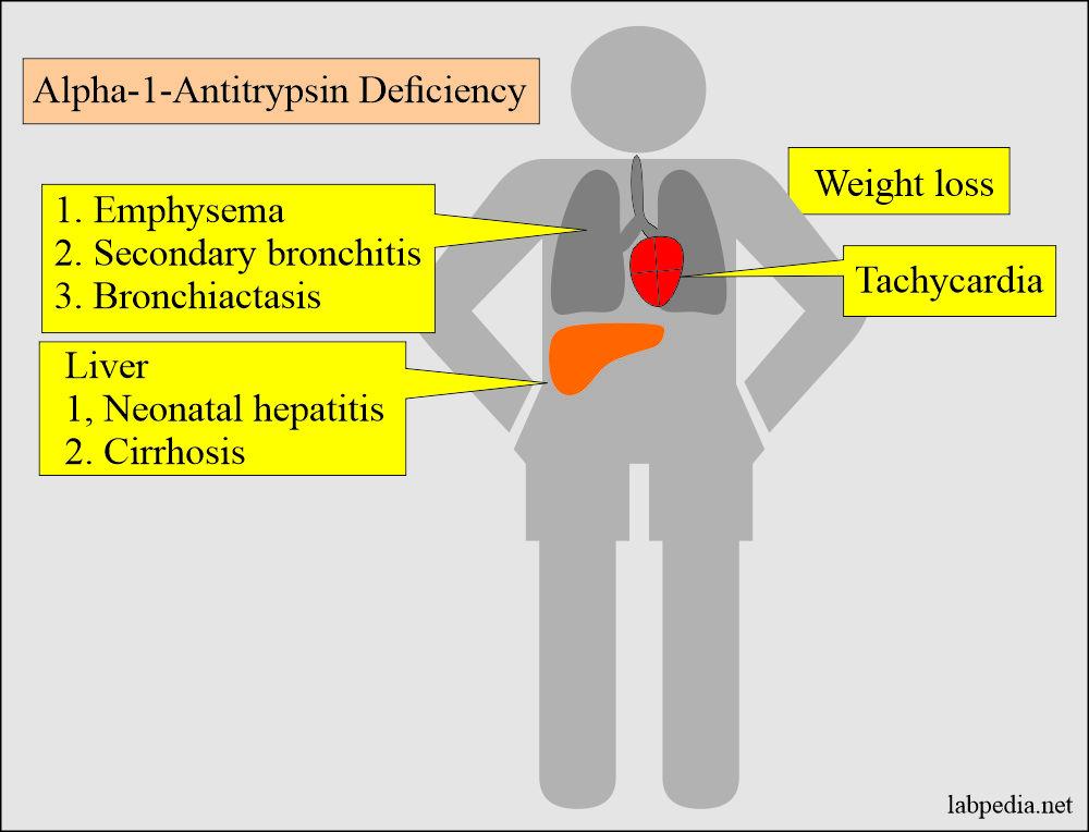 Alpha 1 Antitrypsin Deficiency Causes Effects And 54 OFF