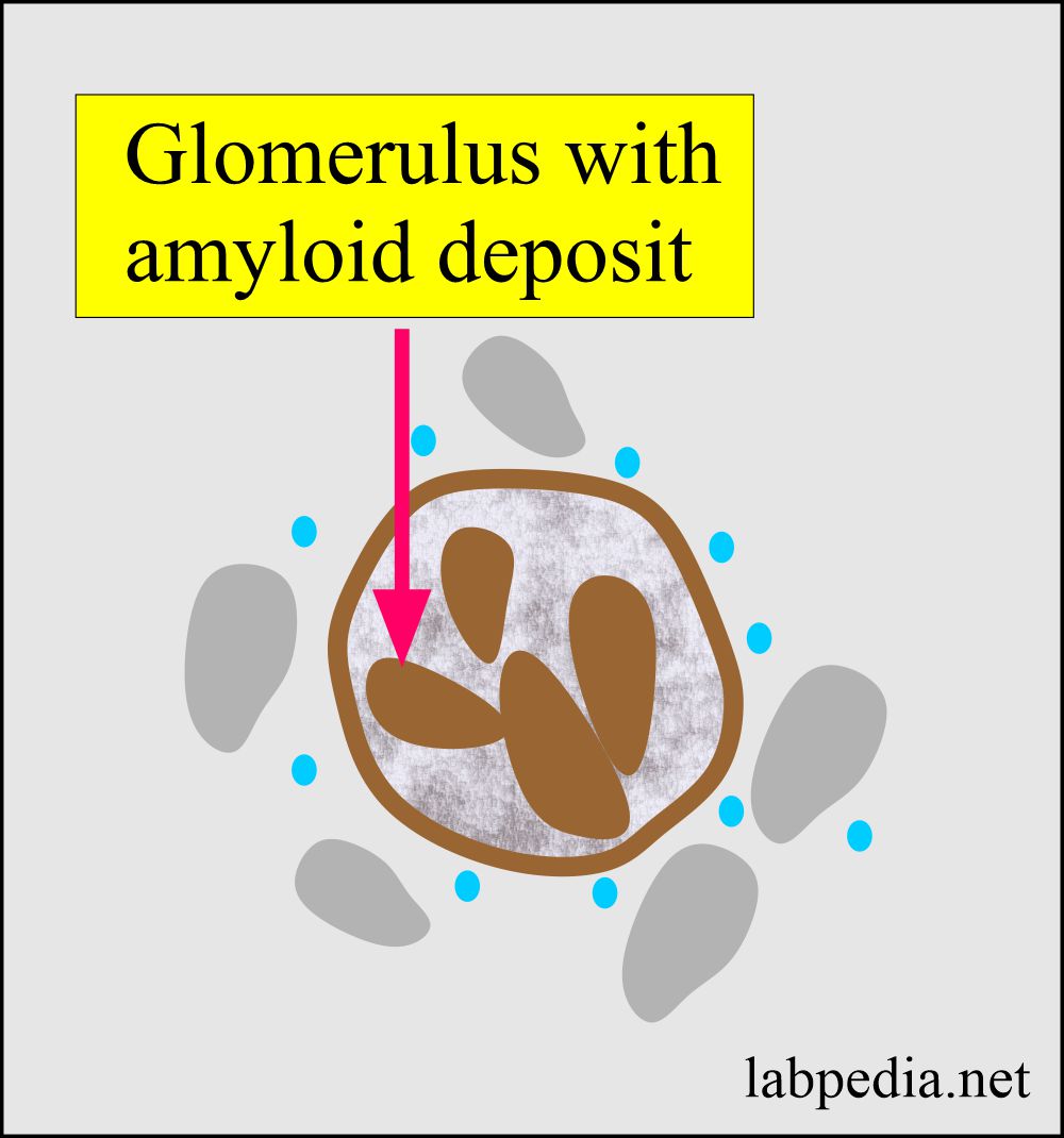 Amyloid deposit in the kidney glomerulus