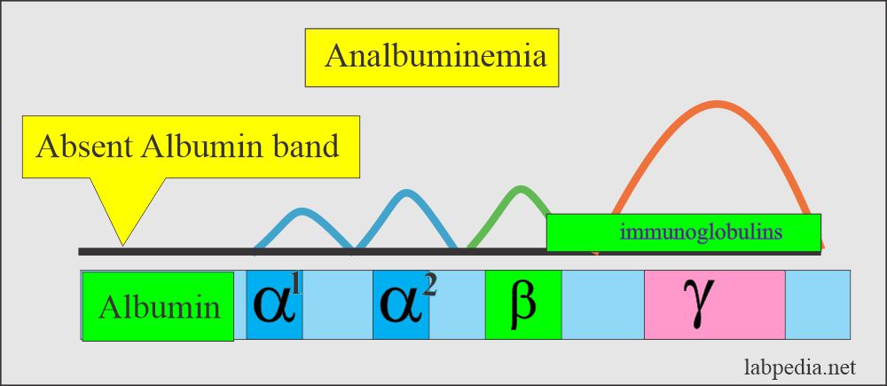 Analbuminemia, electrophoresis showing absent albumin band