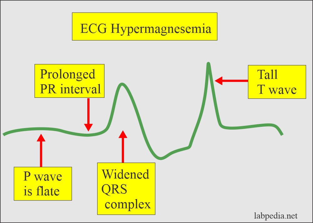 Magnesium level (Mg): ECG changes due to Hypermagnesemia
