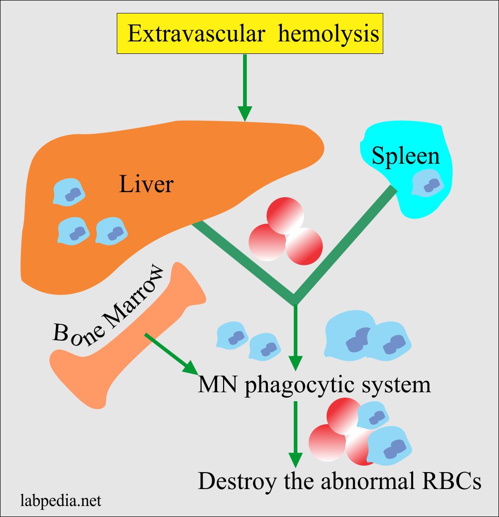 Extravascular Hemolysis