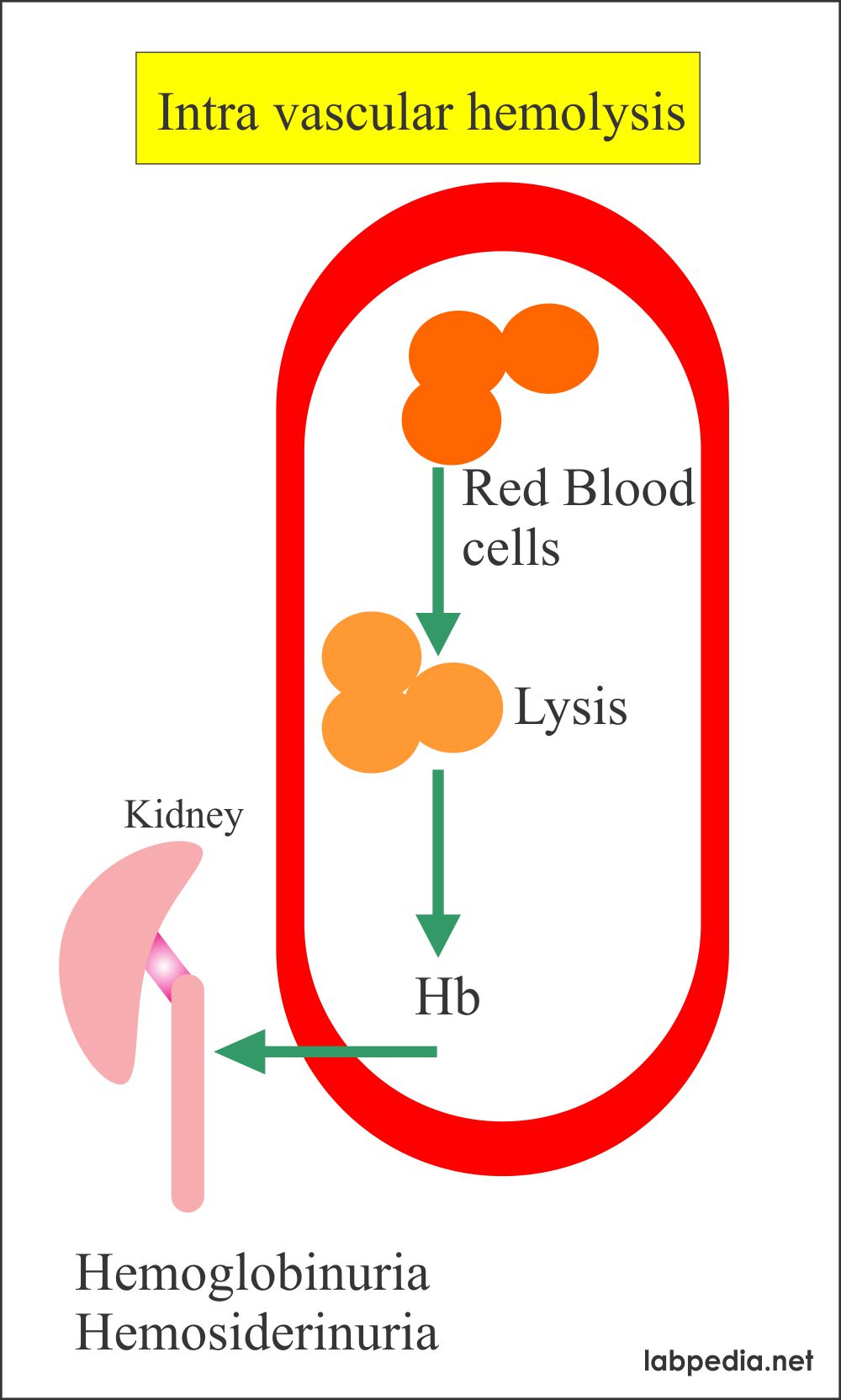 Anemia Part 6 Hemolytic Anemias, Causes and Lab Diagnosis