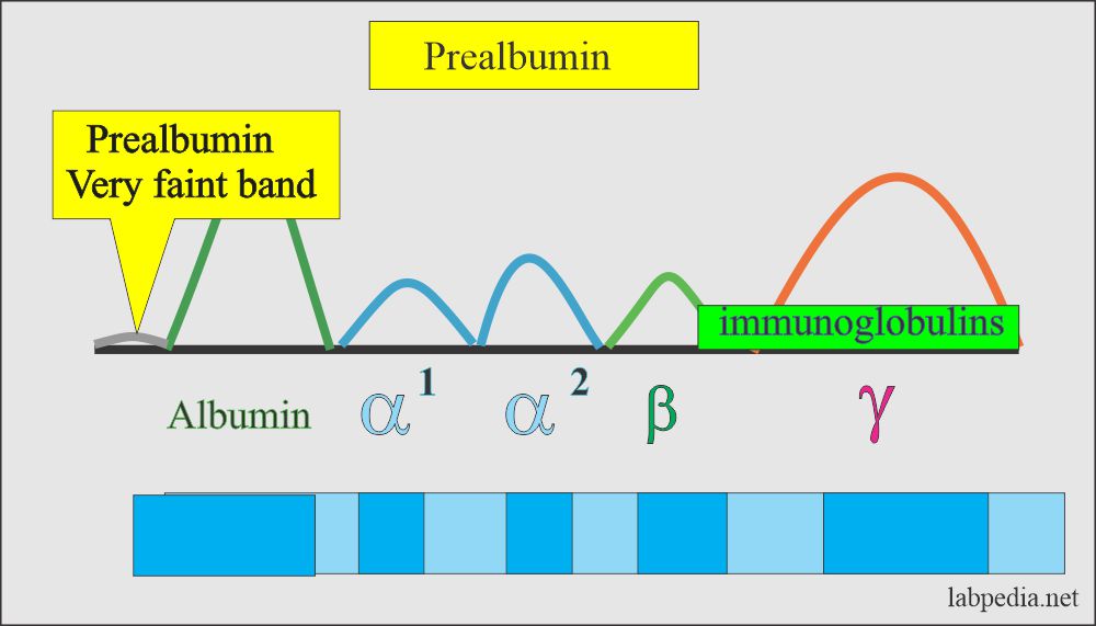 Prealbumin shows very faint band on serum Electrophoresis