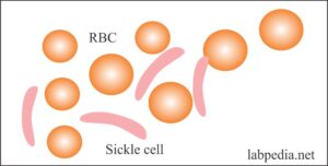 Sickle cell RBCs