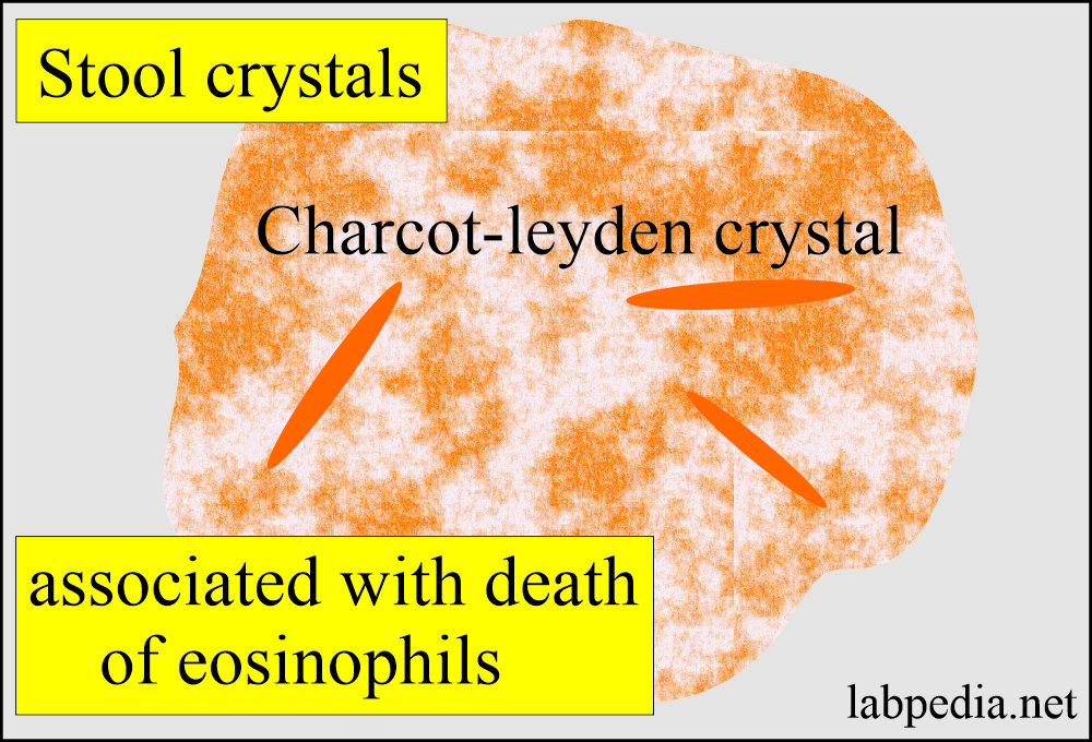 Stool Charcot-Leyden crystals