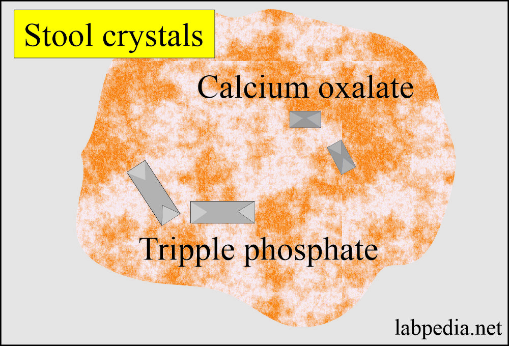Stool examination: Stool showing crystals