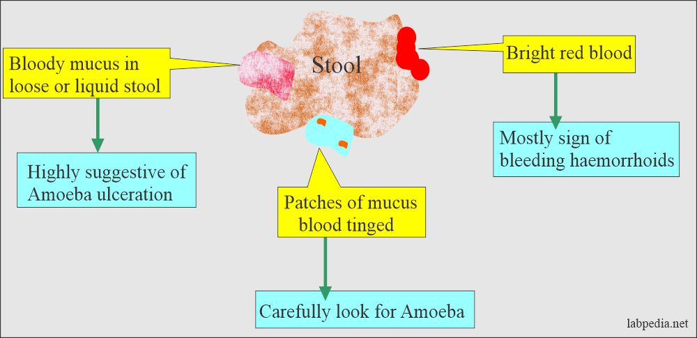 Stool examination: Stool gross appearance of mucus with blood