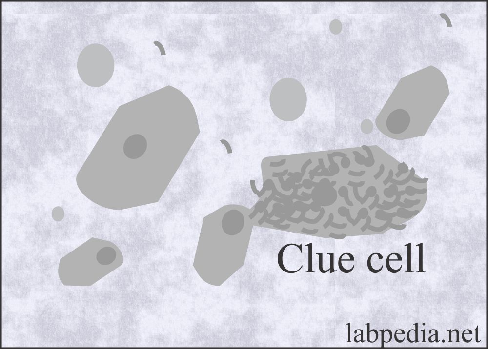Urine analysis, Clue cell