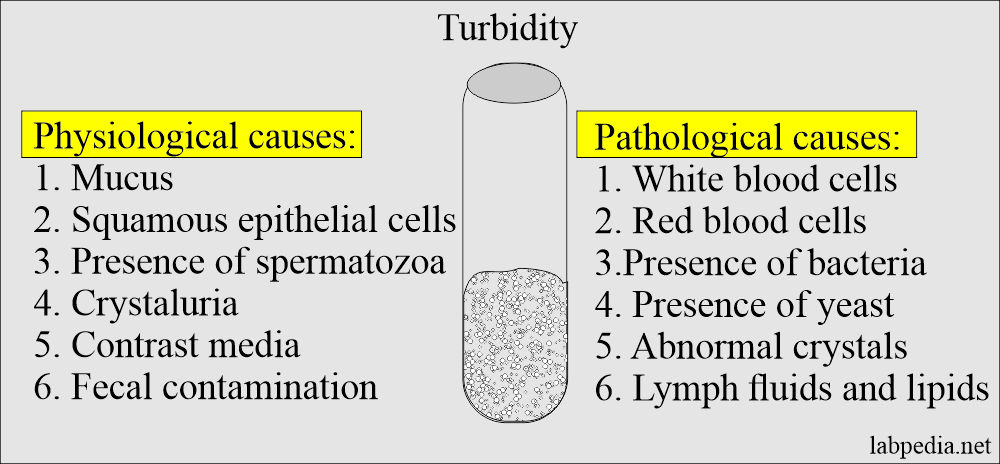 Urine analysis showing turbidity