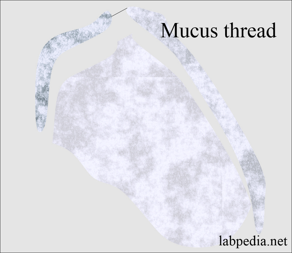 Urine showing mucus threads