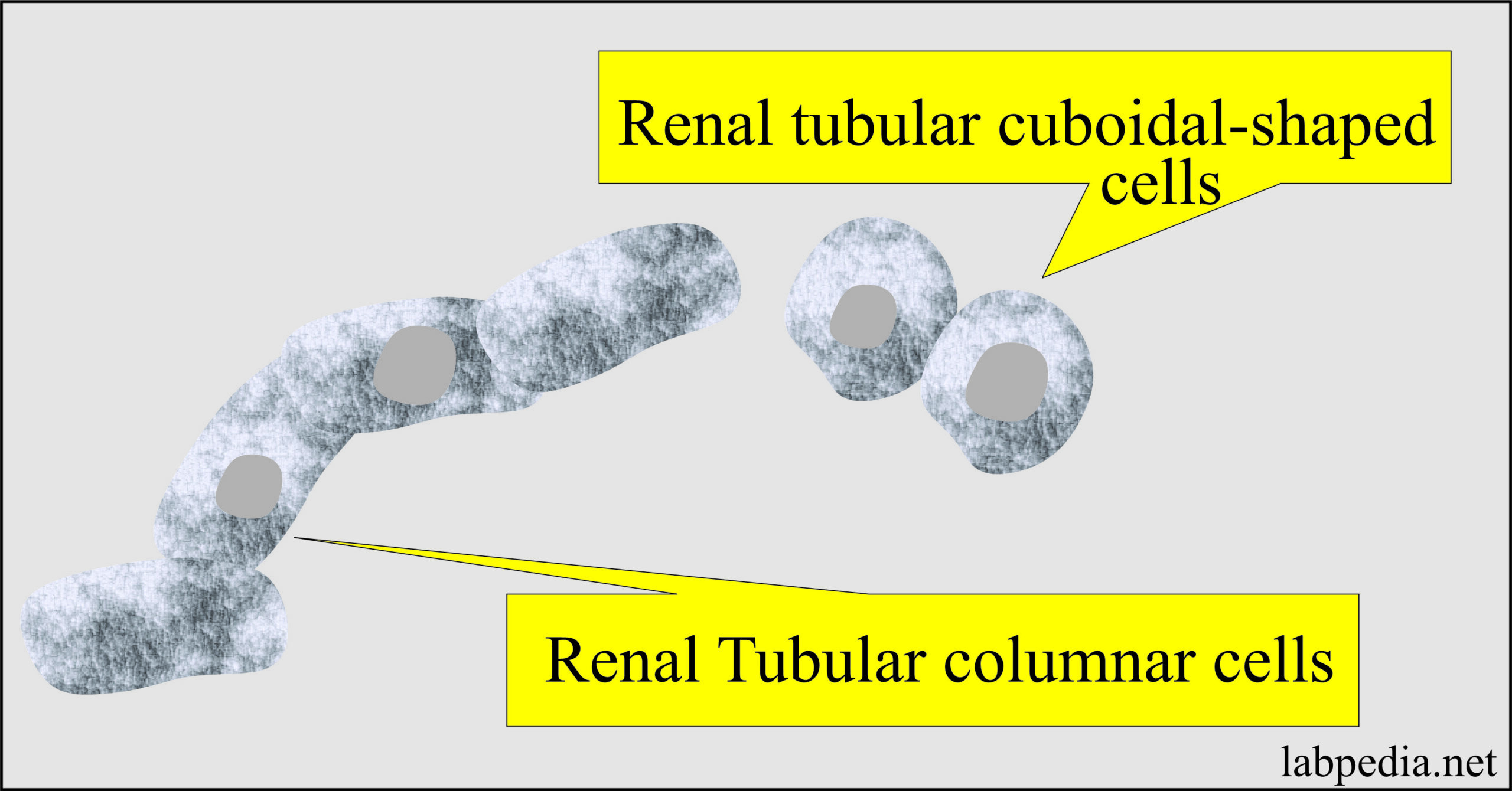Urine analysis, renal tubular epithelial cells
