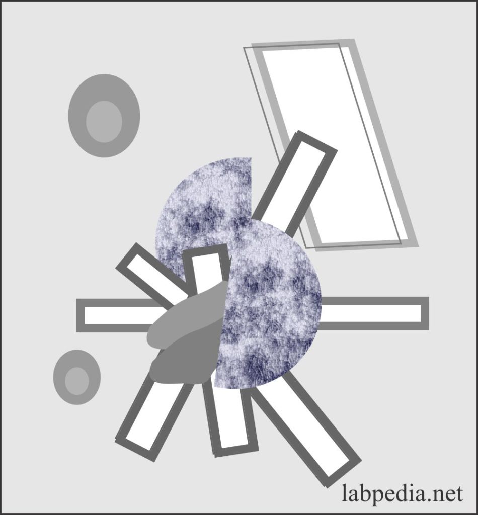 Urine sulfa drug crystals