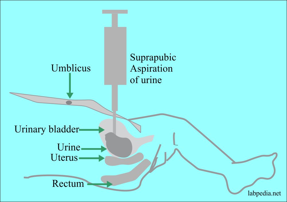 Suprapubic aspiration of the urine from urinary bladder