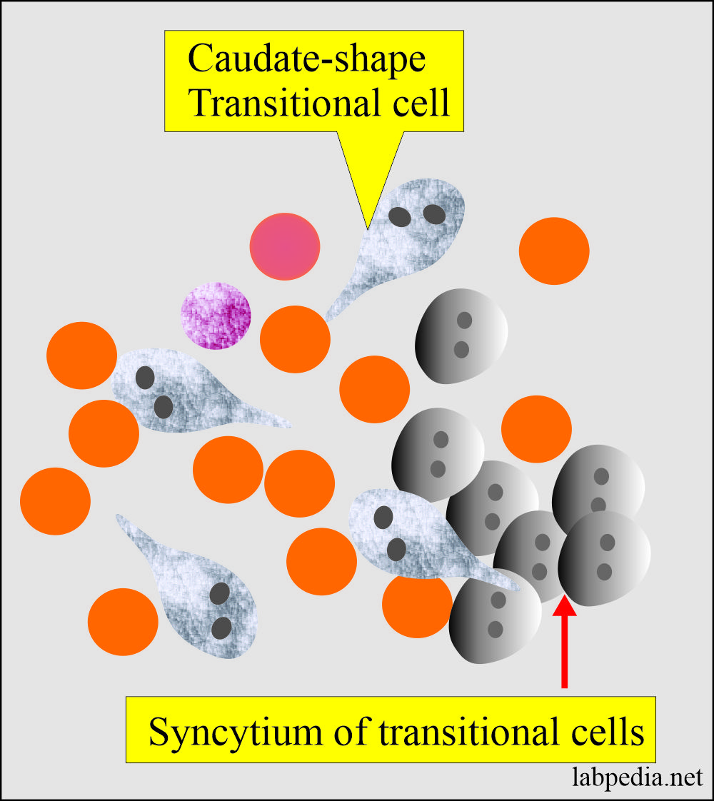 Urine analysis, transitional cells