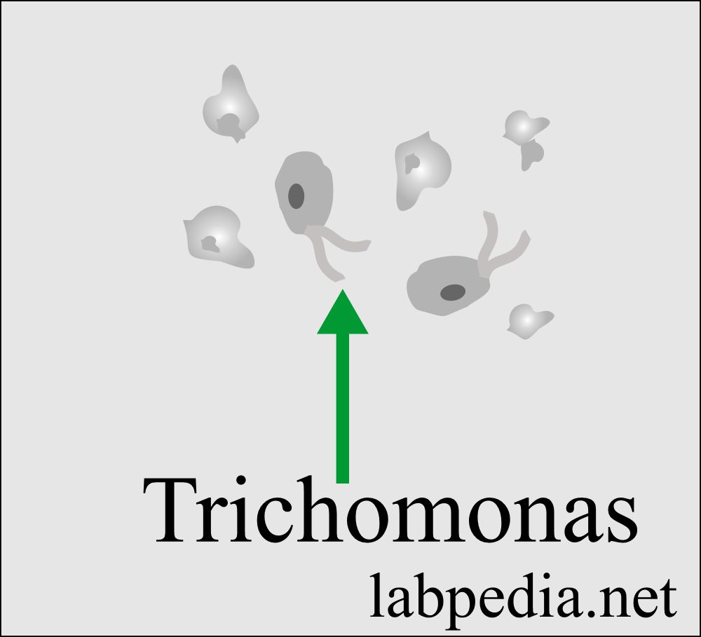 Urine showing trichomonas