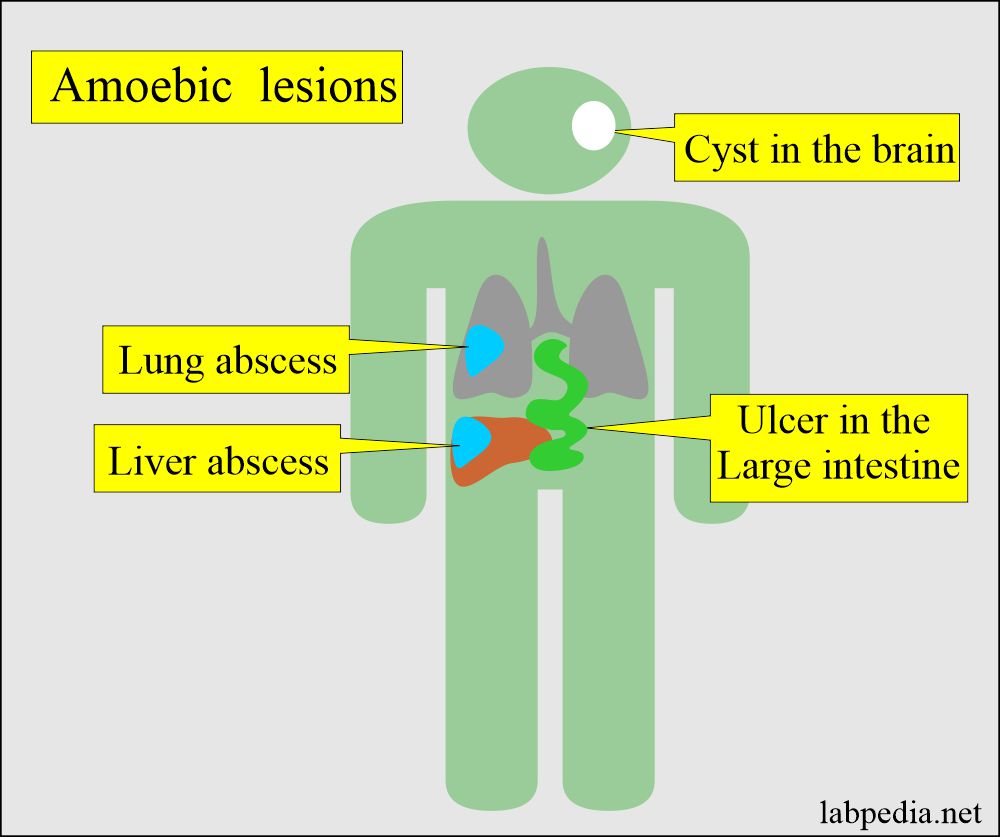 Entamoeba Histolytica lesions in the body 