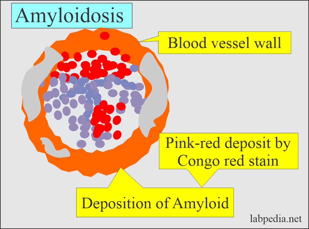Amyloid deposits in the wall of blood vessel